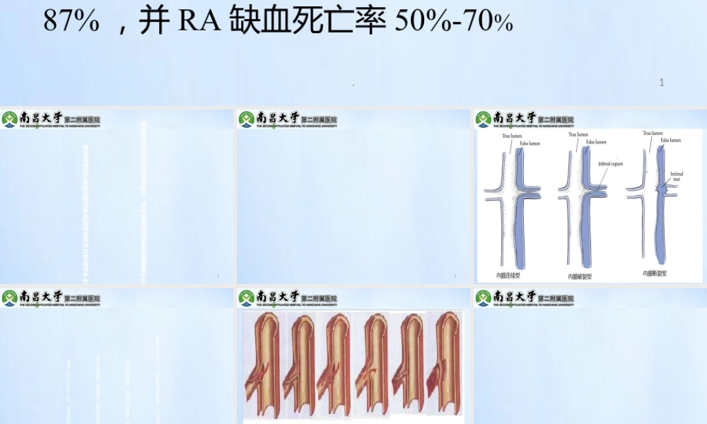 累及内脏动脉的型主动脉夹层的处理精选文档PPT课件