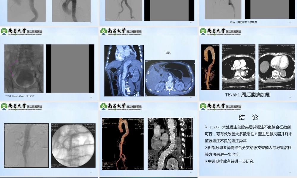 累及内脏动脉的型主动脉夹层的处理精选文档PPT课件