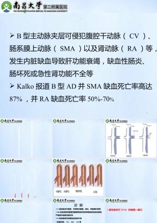 累及内脏动脉的型主动脉夹层的处理精选文档PPT课件